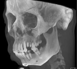 Orbital and Facial Bone Fracture - CTisus CT Scan