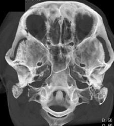 Orbital Rim Fracture - CTisus CT Scan