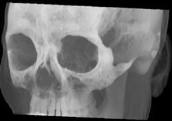 Normal Orbit - CTisus CT Scan