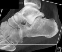 Sclerosis Due to Tarsal Coalition - CTisus CT Scan