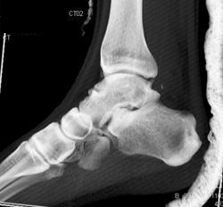 Talus Fracture - CTisus CT Scan