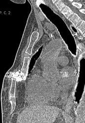 Sternal Fracture With Nonunion - CTisus CT Scan