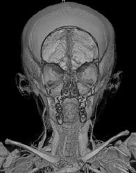 Normal Pediatric Skull in 3D - CTisus CT Scan