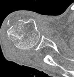 Humerus Fracture - CTisus CT Scan