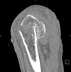 Humerus Fracture - CTisus CT Scan