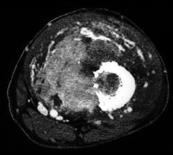 Metastatic Lung Cancer - CTisus CT Scan