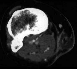 Abscess Behind Knee - CTisus CT Scan