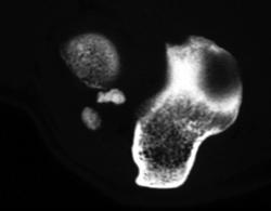 Joint Mice Elbow - CTisus CT Scan