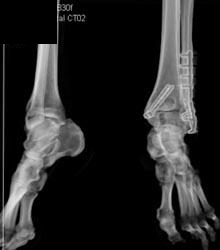 Open Reduction Internal Fixation (ORIF) in Right Leg Ankle - CTisus CT Scan