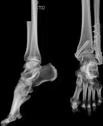 Post Open Reduction Internal Fixation (ORIF) - CTisus CT Scan