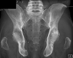 Metastases to the Left Acteabulum - CTisus CT Scan