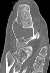 Unicameral Bone Cyst - CTisus CT Scan