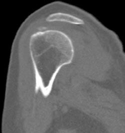 Calcification in Rotator Cuff - CTisus CT Scan