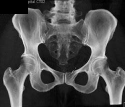 Fracture Symphysis Pubis - CTisus CT Scan