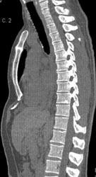 Pectus Deformity - CTisus CT Scan