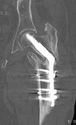 Non-union Femur Fracture - CTisus CT Scan