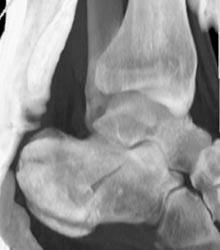 Calcaneal Fracture - CTisus CT Scan