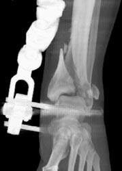 Tibia and Fibular Fractures - CTisus CT Scan