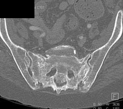 Stress Fracture - CTisus CT Scan