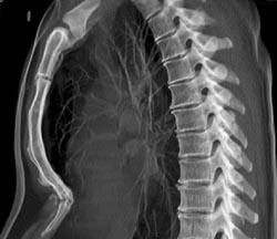 Pectus Deformity - CTisus CT Scan