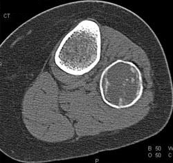 Ewing Sarcoma - CTisus CT Scan