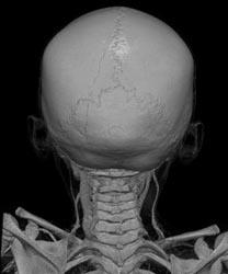 Normal Sutures - CTisus CT Scan