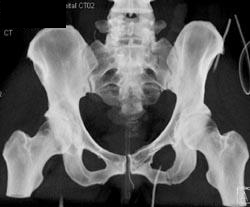 Sacrum and Symphysis Fractures - CTisus CT Scan