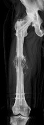 Sarcoma With Pathologic Fracture - CTisus CT Scan