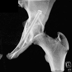 Pinning of Acetabular Fracture - CTisus CT Scan