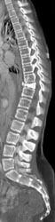 Blastic Metastases Spine - CTisus CT Scan