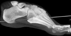 Calcaneal Spur - CTisus CT Scan