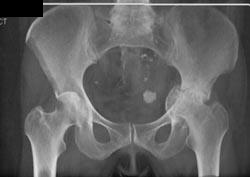 Acetabular Fracture - CTisus CT Scan