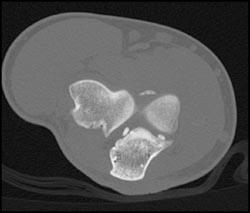 Joint Mice - Musculoskeletal Case Studies - CTisus CT Scanning