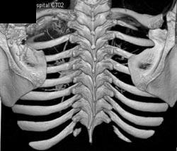 Aneurysmal Bone Cyst (ABC) (see Ribs on Left) - CTisus CT Scan