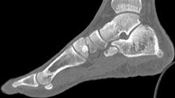 Degenerative Joint Disease (DJD) With Bone Islands - CTisus CT Scan