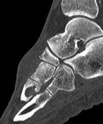 Gout - CTisus CT Scan