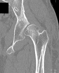 Congential Dysplasia - CTisus CT Scan