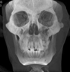 Orbital Fracture - CTisus CT Scan