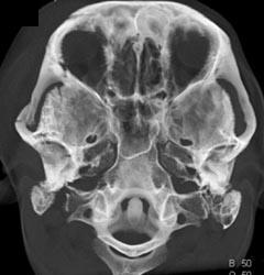 Orbital Fracture - CTisus CT Scan