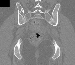 Hemangioma Iliac Bone - CTisus CT Scan