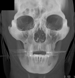 3D Craniofacial Study - CTisus CT Scan