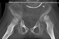 Congential Dislocated Hips - CTisus CT Scan