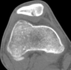 Benign Defect Patella - CTisus CT Scan