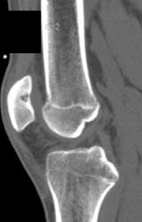 Cartilagenous Lasion Patella - CTisus CT Scan