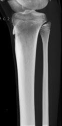 Normal Tibia - CTisus CT Scan