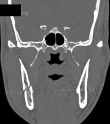 Mandibular Fracture - CTisus CT Scan