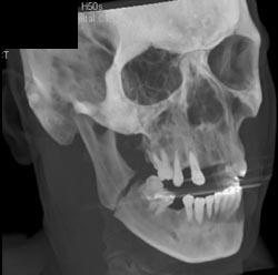 Mandibular Fracture - CTisus CT Scan