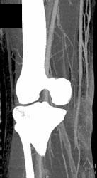 Ct Angiogram Knee - CTisus CT Scan