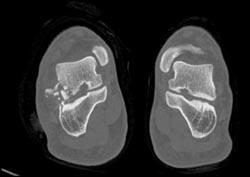 Talus and Calcaneal Fractures - CTisus CT Scan