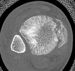 Medial Malleolar Fracture - CTisus CT Scan